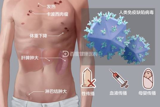 艾滋病(疾病)