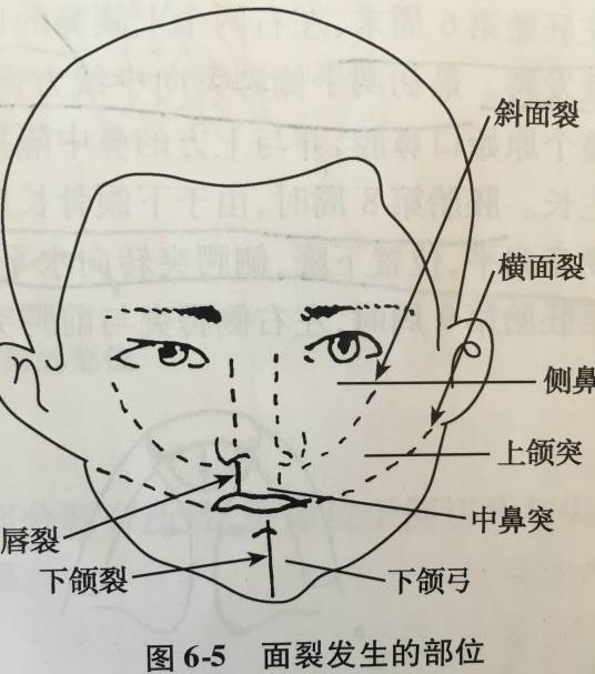 面裂