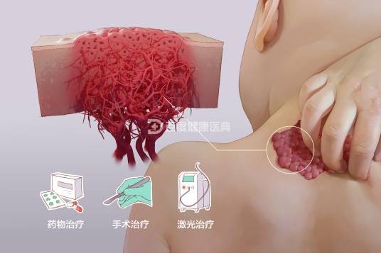 血管瘤