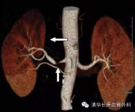 肾动脉狭窄性高血压