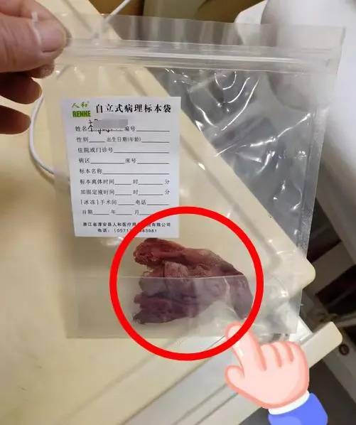 1·5东海女子术后体内遗留纱布事件