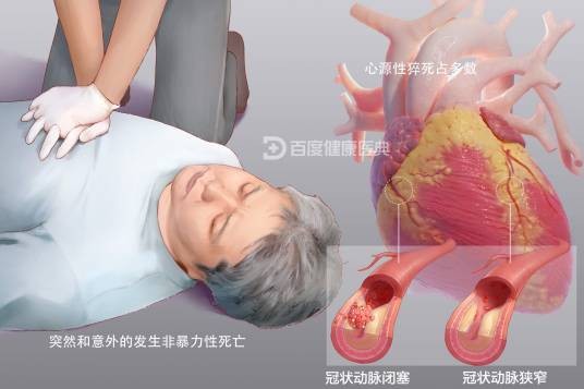 猝死(因病突然死亡)