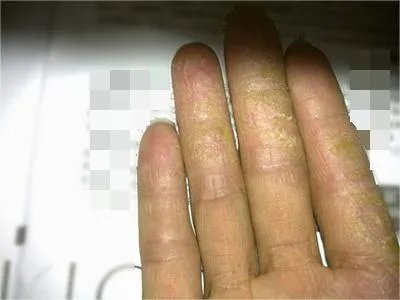 手部湿疹手指皮肤粗糙图片