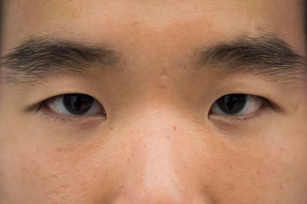 中国人正常瞳孔图片