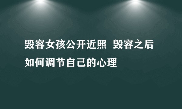 毁容女孩公开近照  毁容之后如何调节自己的心理