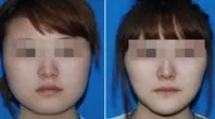 北京打注射瘦脸整形哪个医院好？