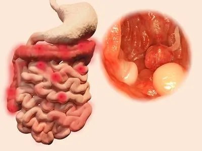 大肠息肉的治疗方法有哪些