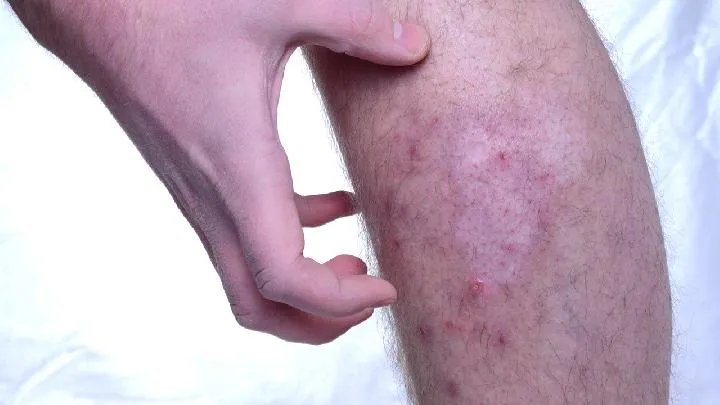 皮炎的中医治疗方法