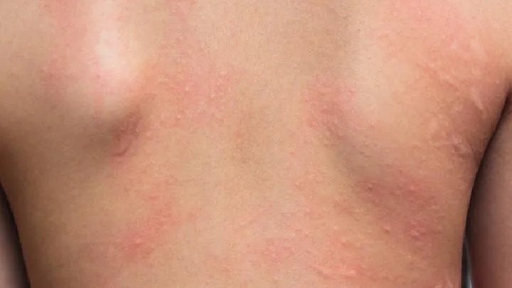 痤疮的治疗选择哪家医院好
