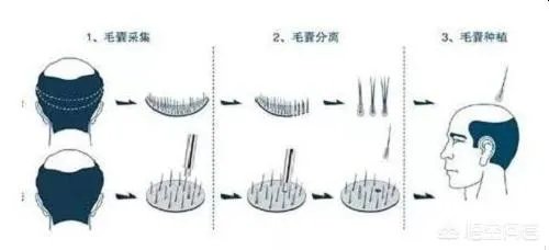 鲁尼植发这件事,大家这么看?