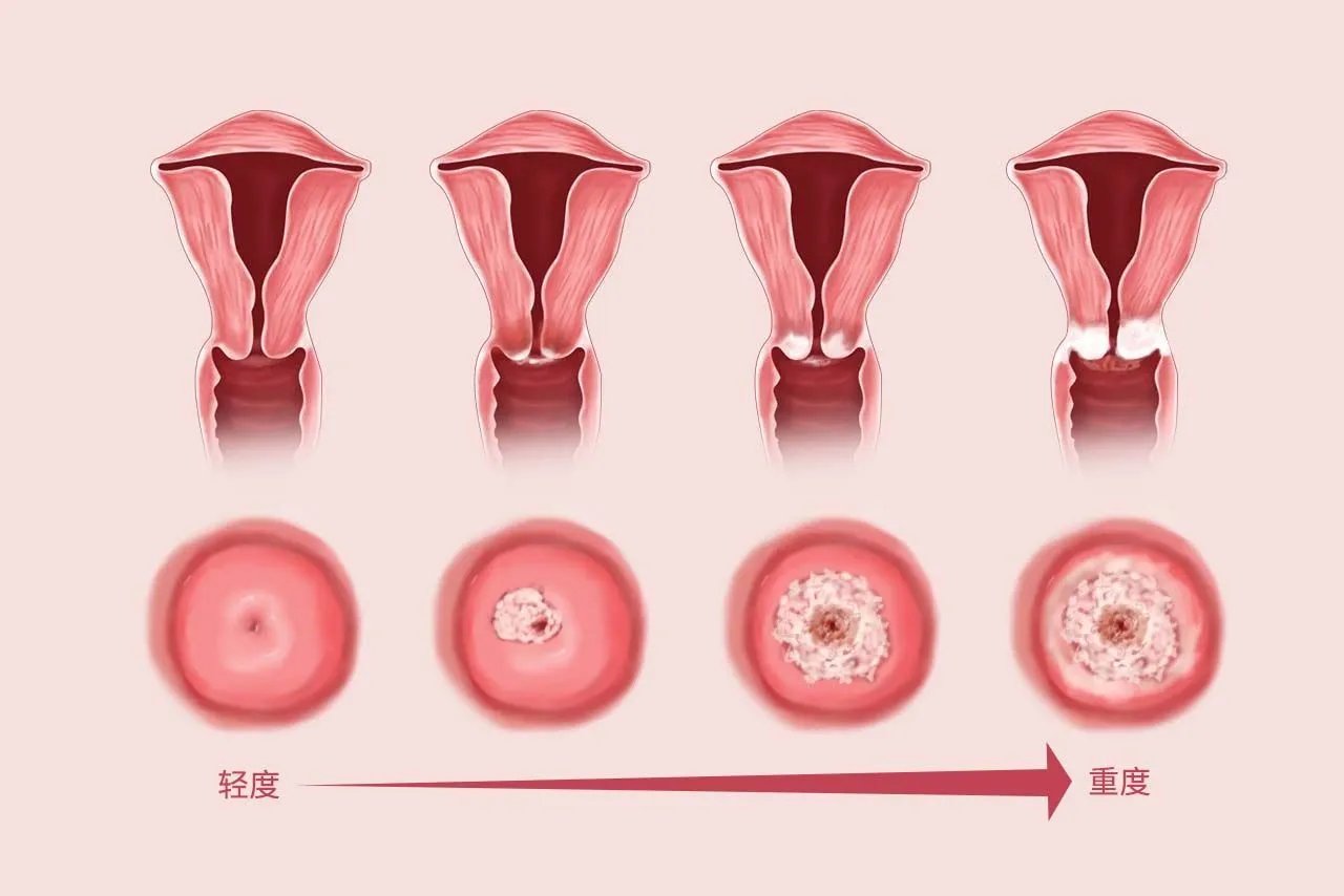 女性霉菌感染早期与重度图片对比