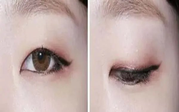开眼角双眼皮