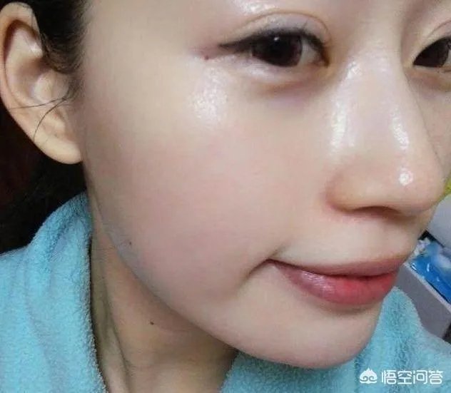 遗传斑点怎么去除?
