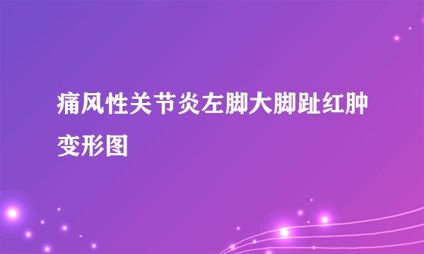 痛风性关节炎左脚大脚趾红肿变形图