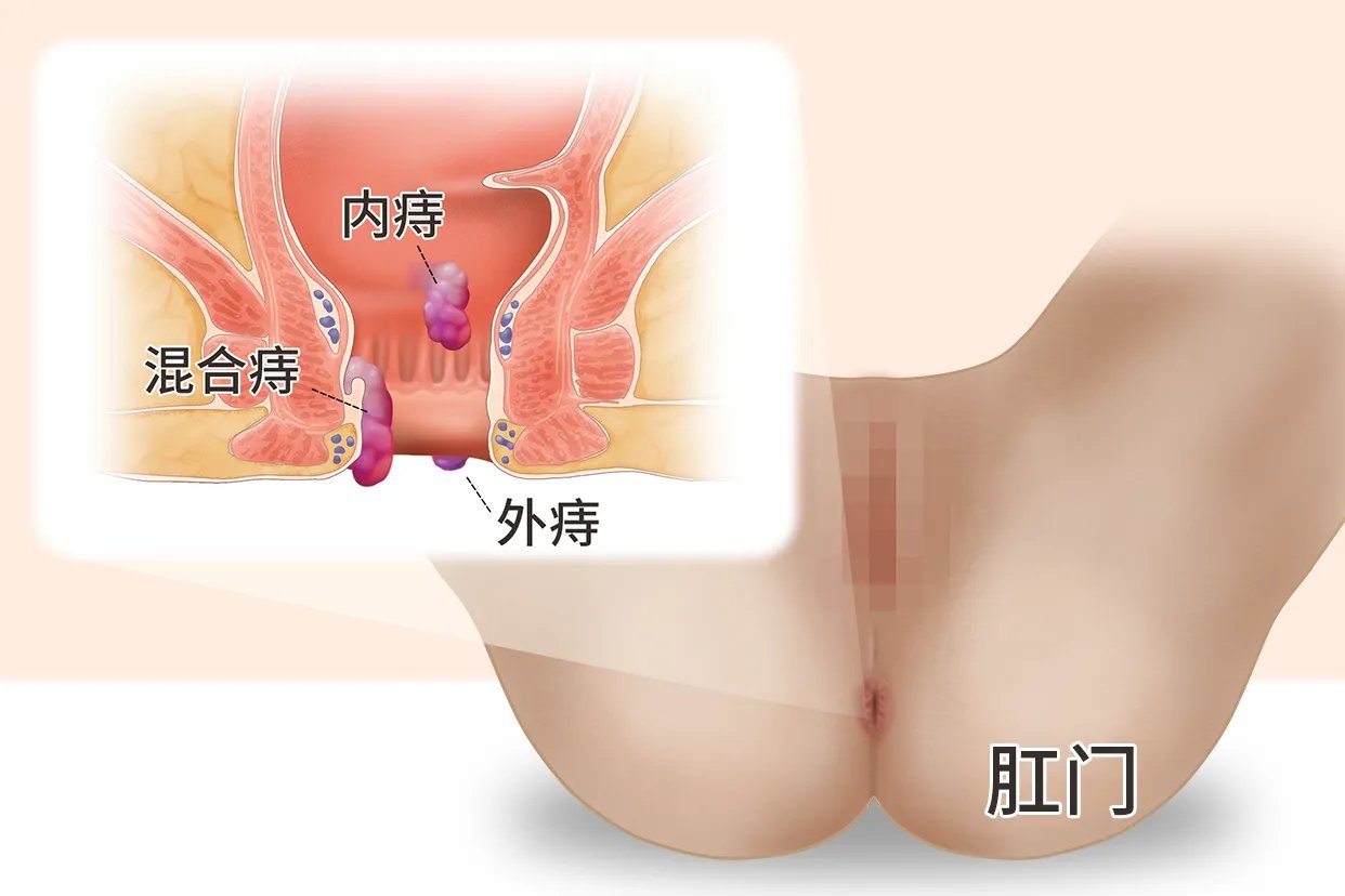 女性长痔疮的症状有哪些图片