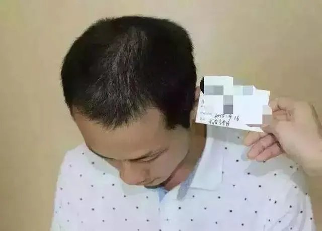 鲁尼植发这件事,大家这么看?