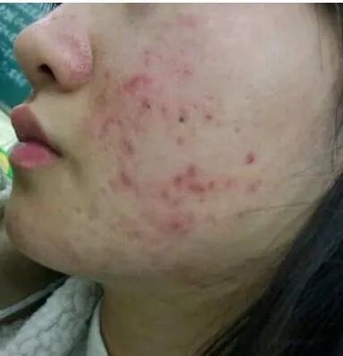 遗传斑点怎么去除?
