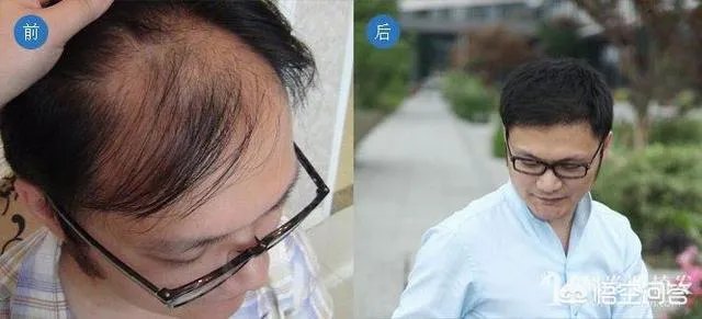 鲁尼植发这件事,大家这么看?