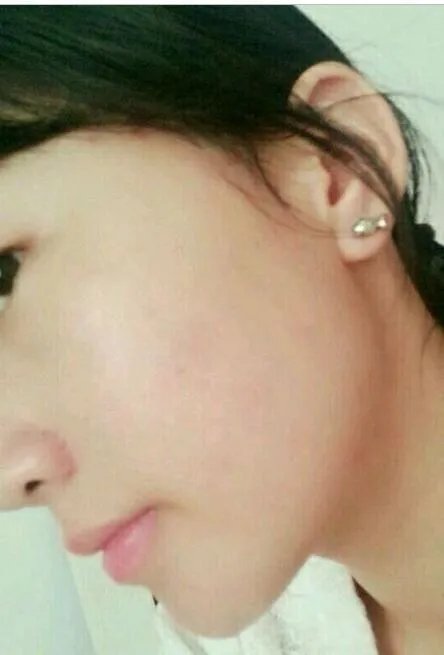 遗传斑点怎么去除?