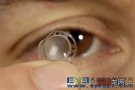 2023年买一个眼角膜多少钱