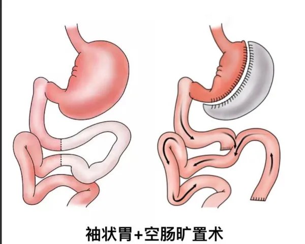 杨天真要去做切胃手术，切胃对我们身体有什么好处吗？