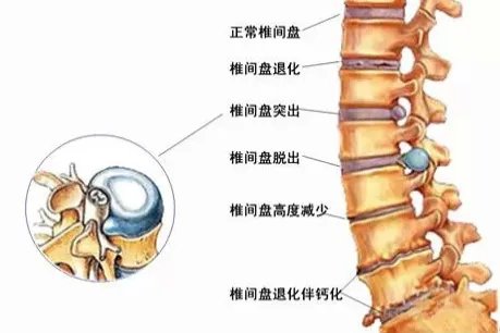 腰椎间盘图