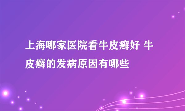 上海哪家医院看牛皮癣好 牛皮癣的发病原因有哪些