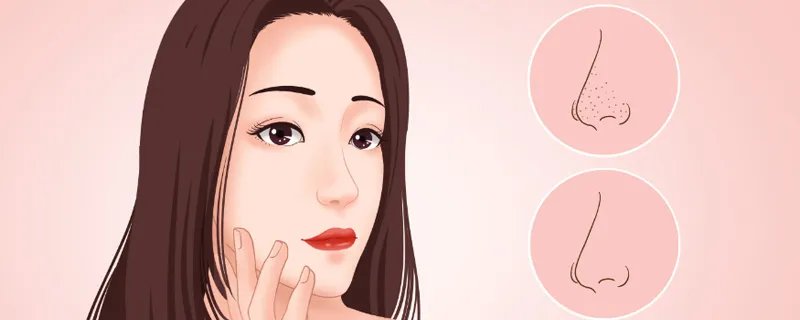 怎样去黑头 去黑头的方法