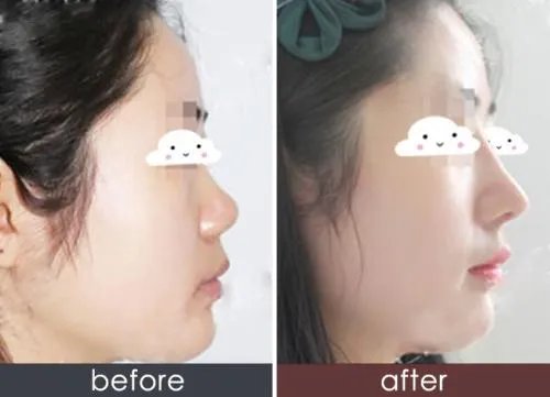 重庆硅胶隆鼻要多少钱？