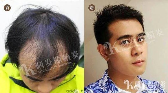 鲁尼植发这件事,大家这么看?