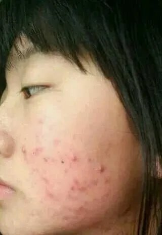 遗传斑点怎么去除?
