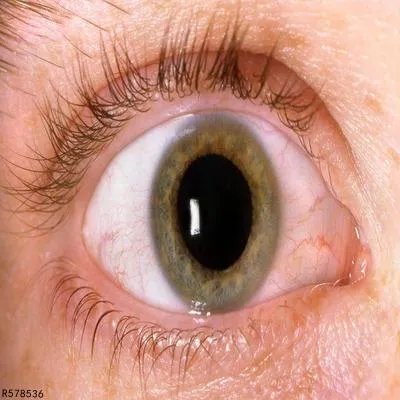 怎样治疗视网膜母细胞瘤