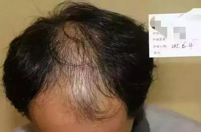 鲁尼植发这件事,大家这么看?