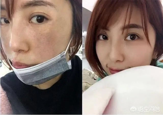 遗传斑点怎么去除?